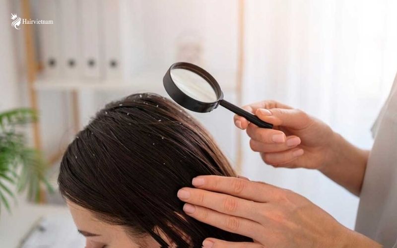 What is Dry Scalp?