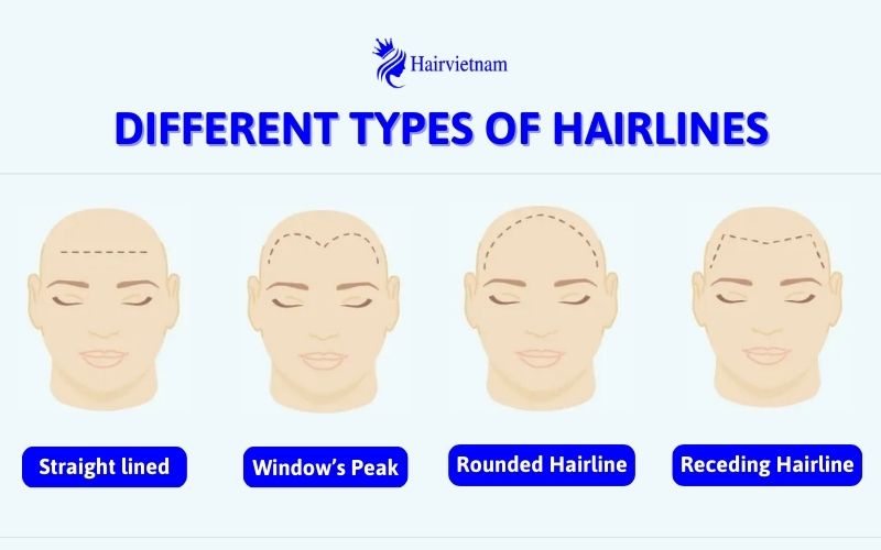 Different types of hairlines